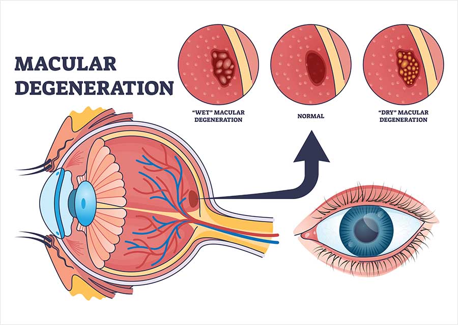 Diagram of an eye in cross-section, with an arrow pointing from the macula at the back of the eye to three enlarged circles comparing a normal macula with wet and dry macular degeneration.