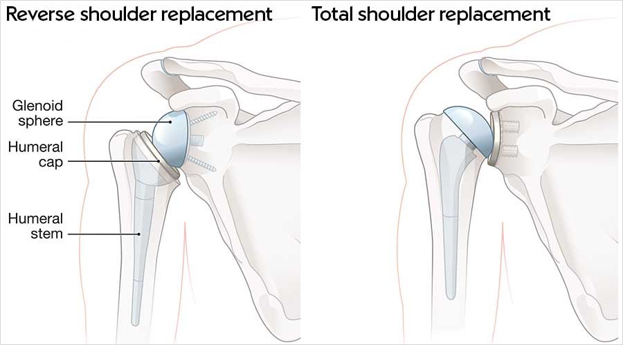 Side-by-side diagrams comparing a reverse shoulder replacement and a total shoulder replacement, with the glenoid sphere, humeral cap and humeral stem labelled.