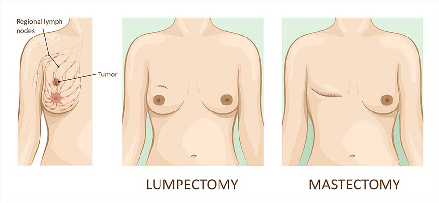 Medical illustration comparing three views of a female chest: a side view showing a tumour in the breast with regional lymph nodes labelled; a front view after lumpectomy, with both breasts present and a small scar; and a front view after mastectomy, with the left breast removed and a horizontal scar across the chest.