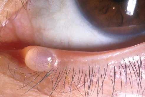 Close-up of a lower eyelid margin showing a small, smooth, translucent dome-shaped cyst sitting among the lashes, typical of a hidrocystoma (cyst of Moll).