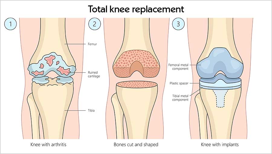 Three-step illustration of a total knee replacement: an arthritic knee with damaged cartilage, the ends of the thigh and shin bones cut and shaped, and the knee fitted with metal and plastic implants.